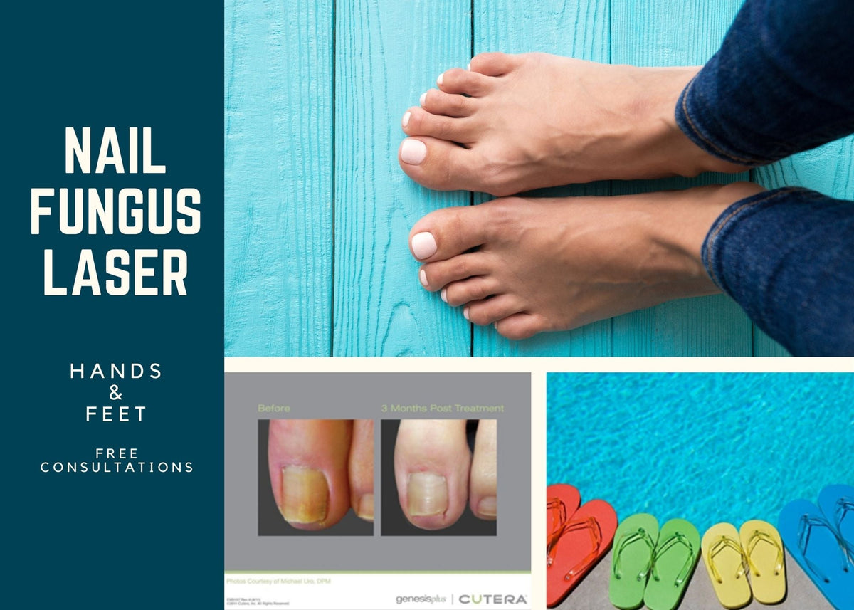 Does Laser Nail Fungus Treatment Work? Exquisite Laser Clinic