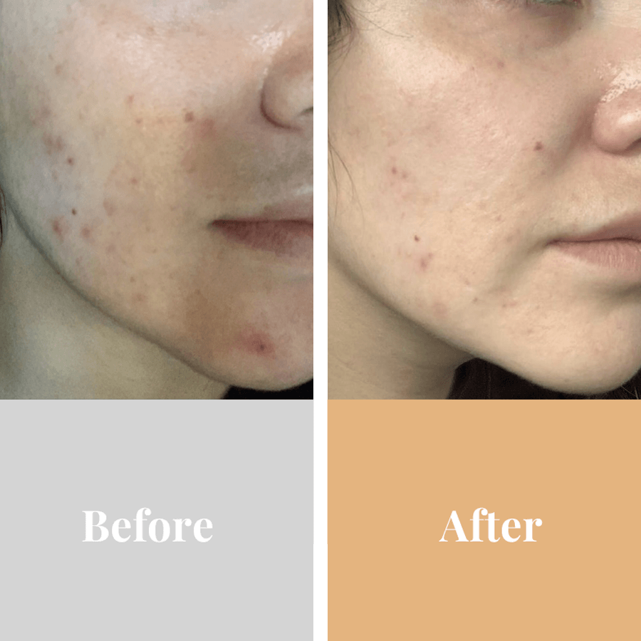 Omnilux Acne CLEAR At home LED Light Treatment - Exquisite Laser Clinic