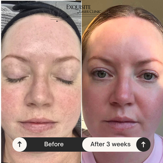 Exquisite Laser Clinic  Cosmelan Package