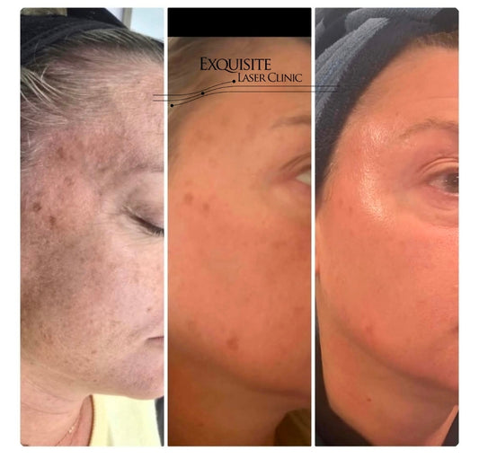 Exquisite Laser Clinic  Cosmelan Package
