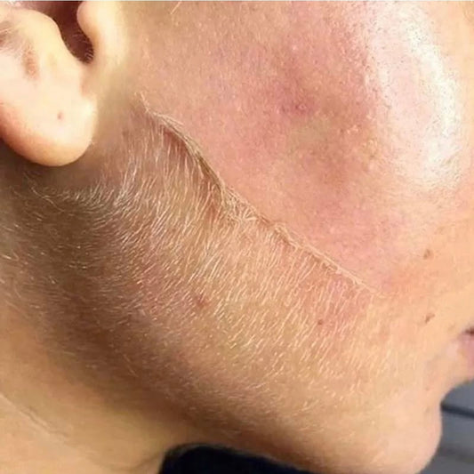 Exquisite Laser Clinic  Health & Beauty Dermaplaning Facial