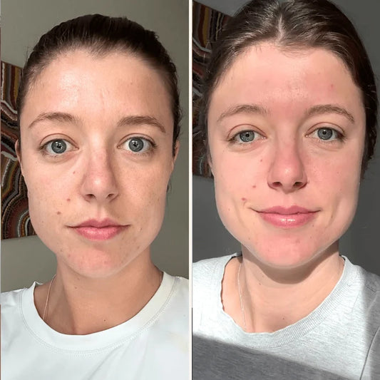 Trudermal Microneedling Infusion Kit - Exquisite Laser Clinic 
