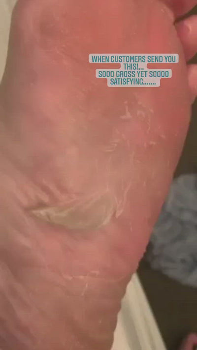 Foot Peel