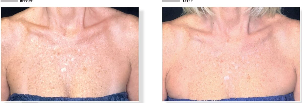 Omnilux Contour NECK & DÉCOLLETÉ **PRE ORDER** - Exquisite Laser Clinic